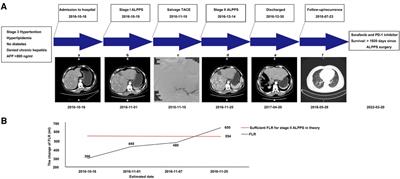Mini-ALPPS-based multidisciplinary treatment leading to long-term survival in a patient with a large HCC: A case report